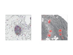 Organización espacial y específica de los tejidos de la senescencia celular (un proceso en el que las células dañadas o envejecidas dejan de dividirse pero permanecen activas). (Fuente de la imagen: The Lancet Digital Health)